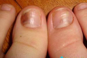 Как избавиться от боли в ушибленном пальце и убрать синяк под ногтем Синяк под ногтем